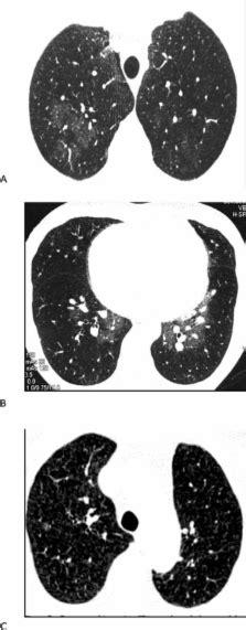 In search of markers of treatment failure and poor prognosis in IPAH - the value of mosaic lung ...