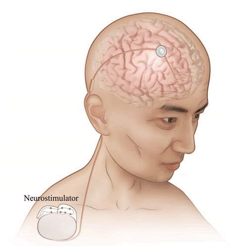 Deep Brain Stimulation: Neurologists implant a neurostimulator to send ...