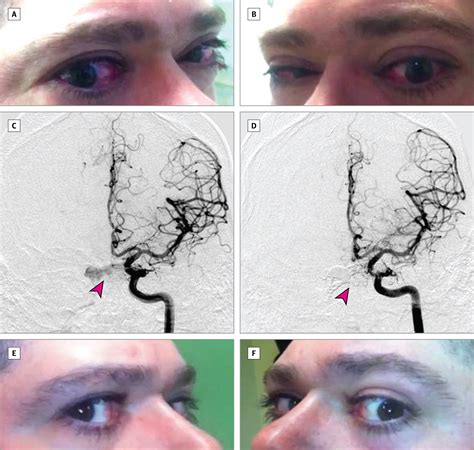 Bilateral Carotid-Cavernous Sinus Fistulas | Cerebrovascular Disease | JAMA Neurology | The JAMA ...