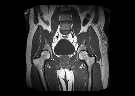 Bony pelvis MRI examination - Medicover