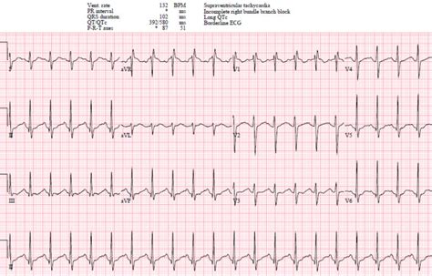 EM Cases | ECG Cases 19: tachycardias