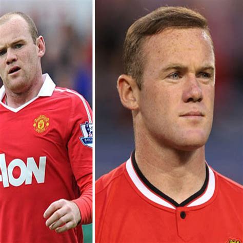 Wayne Rooney Hair Transplant Results