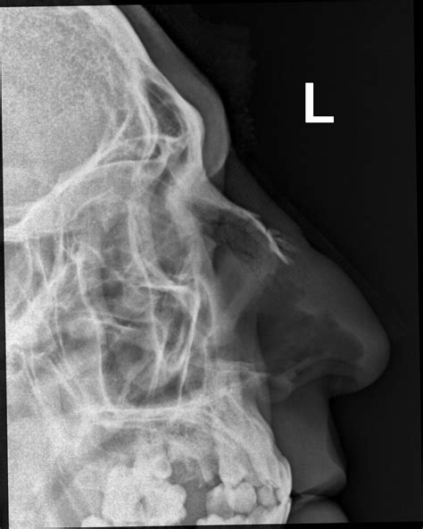 Nasal Bone Fracture Mri - Nasal bone fracture | Radiology Case | Radiopaedia.org - High ...