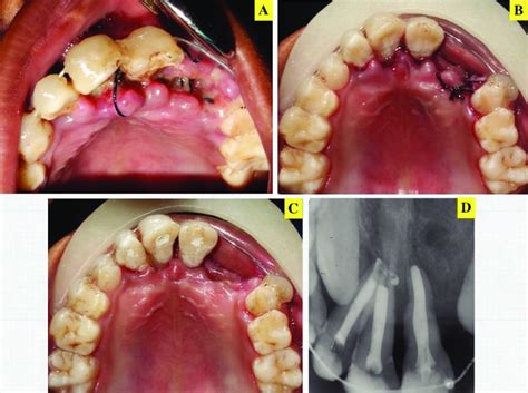 A, One-week follow-up. B, After debridement, full mouth scaling, and... | Download Scientific ...