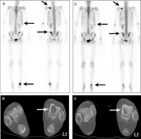 Bone scintigraphy and CT before and after ZA therapy. (A) Bone ...