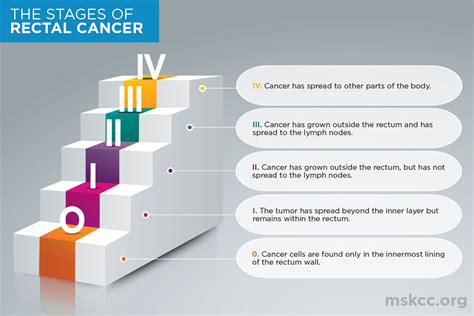 Rectal Cancer Stages 0, 1, 2, 3, 4 | Memorial Sloan Kettering Cancer Center