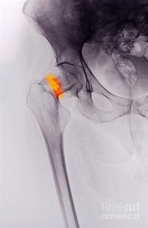 Hip Fracture X-ray Photograph by Scott Camazine