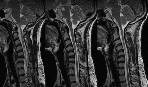 Neuroradiology Cases: Hirayama Disease MRI