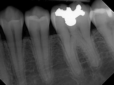 Eliminating the Obstacles and Embracing Dental Digital X-rays | Dentalcompare.com