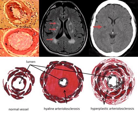 Lacunar stroke | STROKE MANUAL