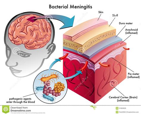 Meningitis. | Dr. Zachary Lahlou