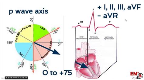 EKG interpretation axis | Ekg interpretation, Ekg, Interpretation