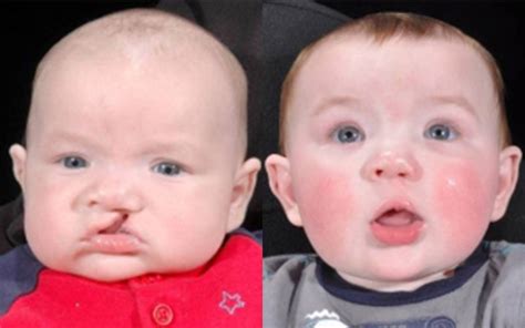 Unilateral Cleft Lip Palate Before & After Pictures in Dallas, TX