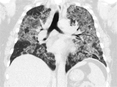 What Does Infiltrates In Lungs Mean - slidesharetrick