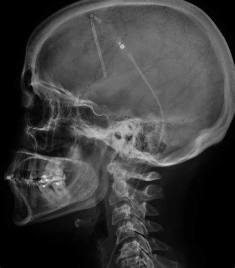 Ventriculoperitoneal (VP) Shunt Catheters - MR IMPLANT