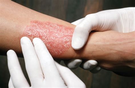 Psoriasis Treatment With Biologics Often Requires Multiple Courses, Treatment Changes