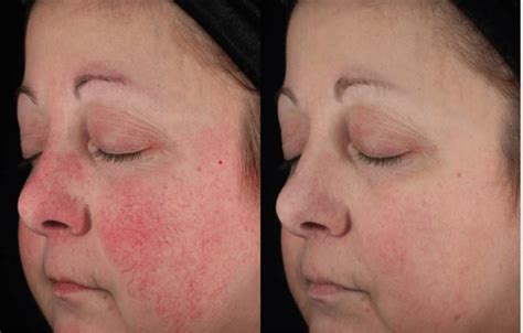 Laser Treatment for Rosacea: Efficacy, Before and Afters, Cost and More