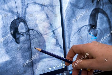 Cardiac Catheterization Performed By Pediatric Cardiologist Editorial ...