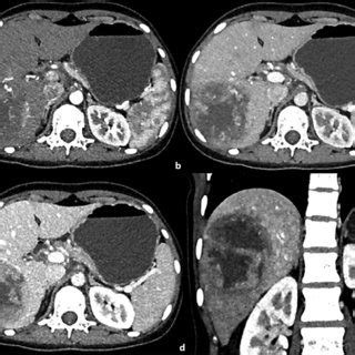 CASE 1: Triple-phase contrast-enhanced CT axial (a-c) and coronal (d)... | Download Scientific ...