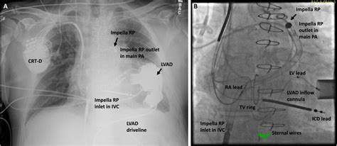 Impella RP and left ventricular assist device (LVAD) in situ. Shown on... | Download Scientific ...