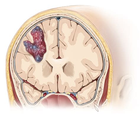 Evaluation of Cavernous Malformations | The Neurosurgical Atlas