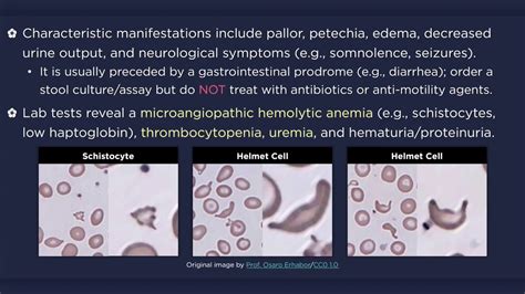 Hemolytic Uremic Syndrome (HUS) - YouTube