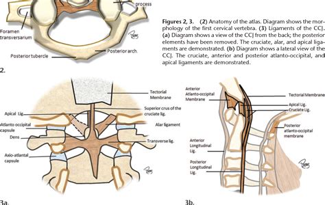 Figure 2 from Imaging of Atlanto-Occipital and Atlantoaxial Traumatic ...