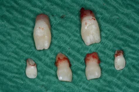 Extraction of deciduous and supernumerary teeth. | Download Scientific Diagram