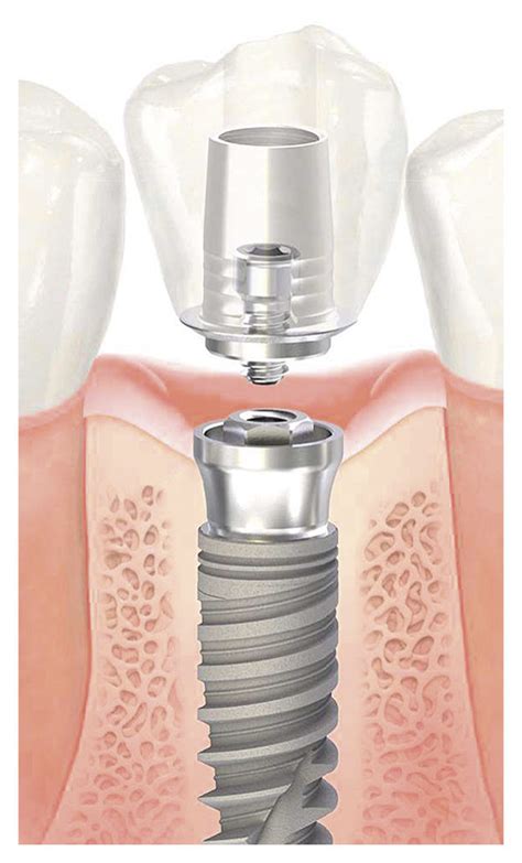 Design of a dental implant system: screw-shaped implant, a prosthetic... | Download Scientific ...