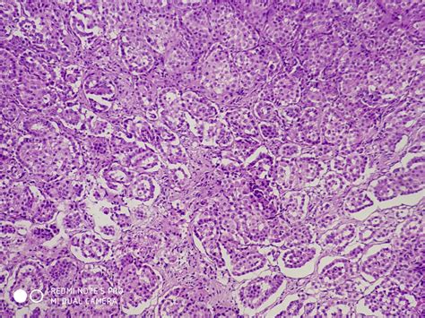 EPITHELIAL MALIGNANT MESOTHELIOMA – Histopathology.guru