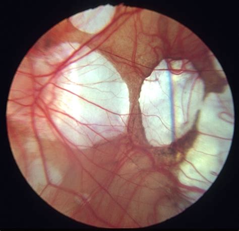 Myopic macular degeneration - Retina Image Bank