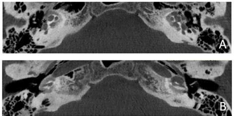 CT images of patient #4 with otosclerosis. A and B, axial plane. The ...