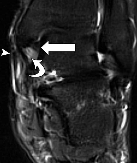 MR Imaging of Deltoid Ligament Pathologic Findings and Associated Impingement Syndromes ...