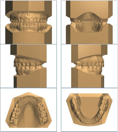 Study Models - Excel Orthodontics