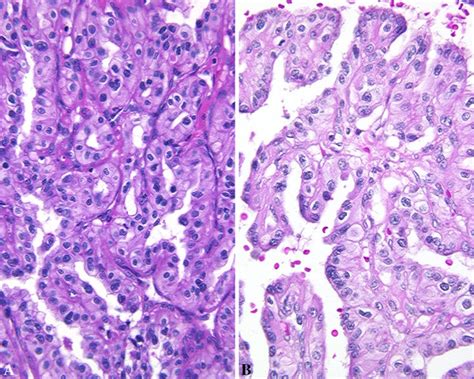 Aggressive papillary tumor. The tumor shows complex papillary ...