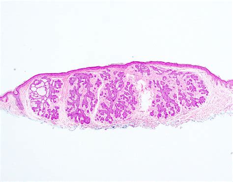 Pathology Outlines - Trichoepithelioma / trichoblastoma