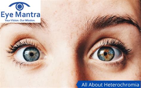 Heterochromia- Types, Causes, Diagnosis, Remedies And Treatment