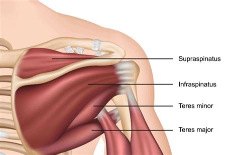 Shockwave therapy for calcifc tendinopathy/tendinitis | Complete Physio