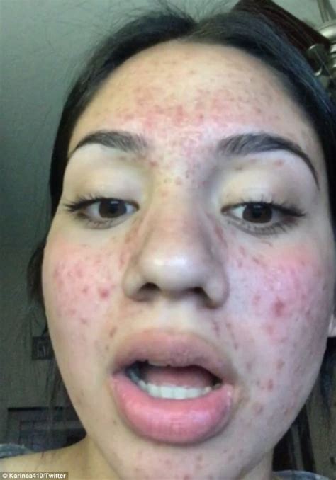 Teenager with bad acne clears skin with drugstore products | Daily Mail ...