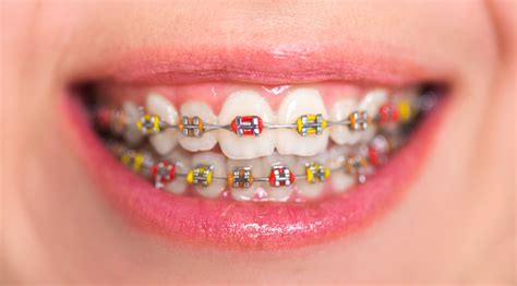 Color Braces Idea Los Angeles, CA - Cosmetic Dentist | Smile Angels of Beverly Hills Bruce Vafa DDS.