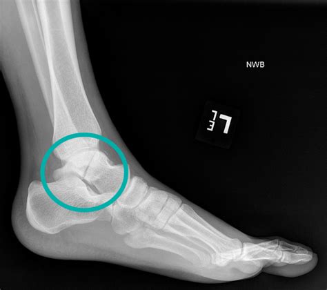 Talar Fracture Surgery | FootCareMD