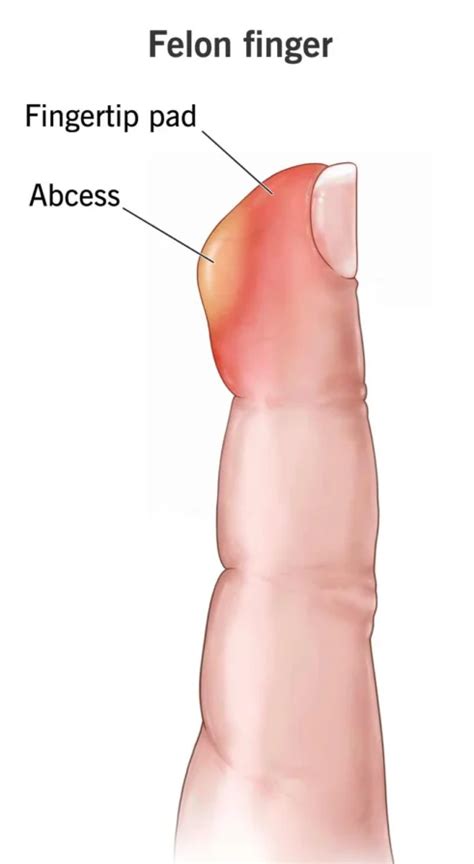 Felon Finger Infection - Causes & Treatment by Homeopathy