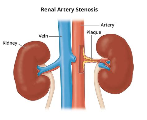 Renal Artery Stenosis - NIDDK