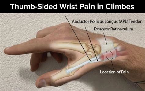 Thumb-Sided Wrist Pain in Climbers: A Case for De Quervain’s ...