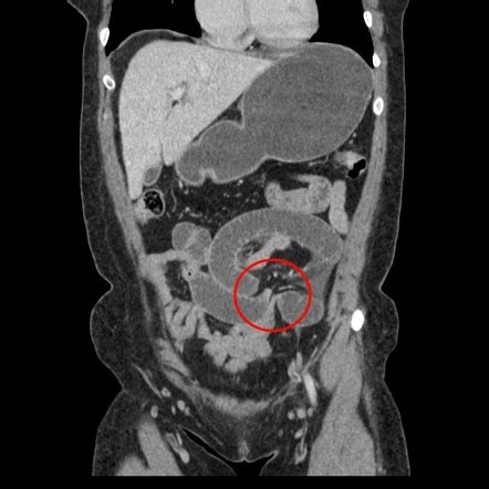 Closed loop obstruction | Radiology Reference Article | Radiopaedia.org