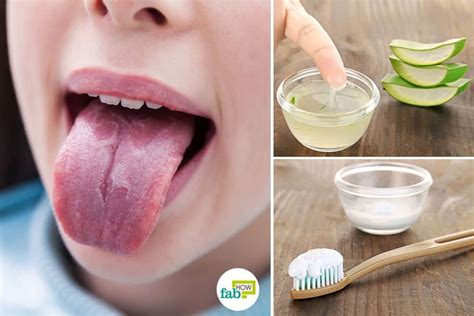 7 Home Remedies to Get Rid of Burning Mouth Syndrome | Burning mouth syndrome, Burning tongue ...