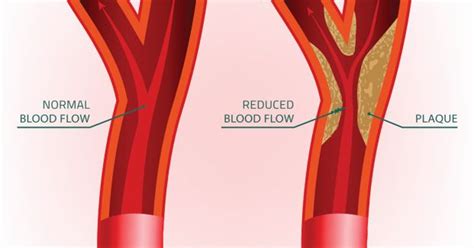 Coronary Calcium Scan results then vs. now