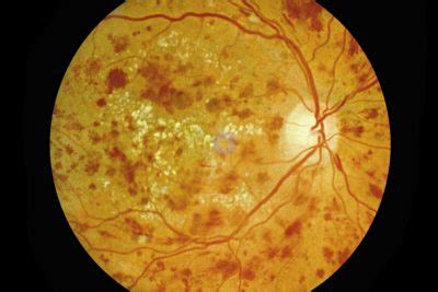 Understand the Four Stages of Diabetic Retinopathy