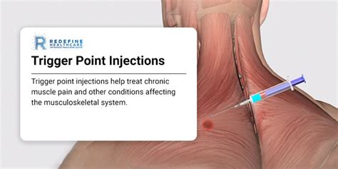 Trigger Point Injection NJ - Redefine Healthcar