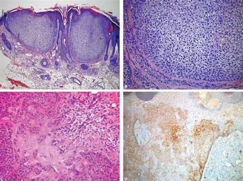 Trichilemmoma. A. Typical lobular architecture in close relation with... | Download Scientific ...